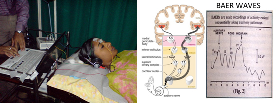 Figure panel showing (a) BERA (Brainstem evoked response audiometry) of