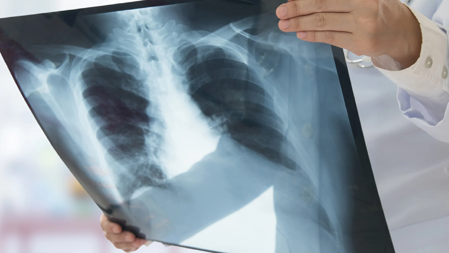 Digital X-Ray Test in Bhopal at Chandan Diagnostic Centre